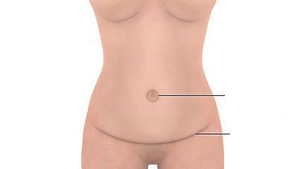 abdominoplasty-scars